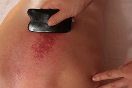 Gua Sha Kamm aus Horn wird an Haut gerieben und es entstehen Petechien, welche rote Punkte auf der Haut sind