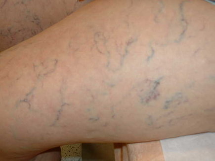 Beine mit einer Besenreiser Neigung Oberschenkel mit vielen blauen Äderchen die man Besenreiser nennt